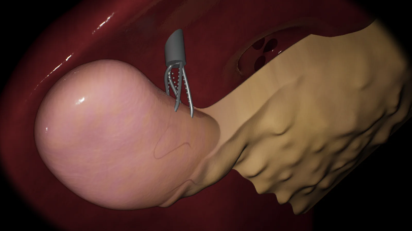 Laparoscopic view inside the OpenSurgery simulation environment